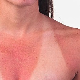 sun burn